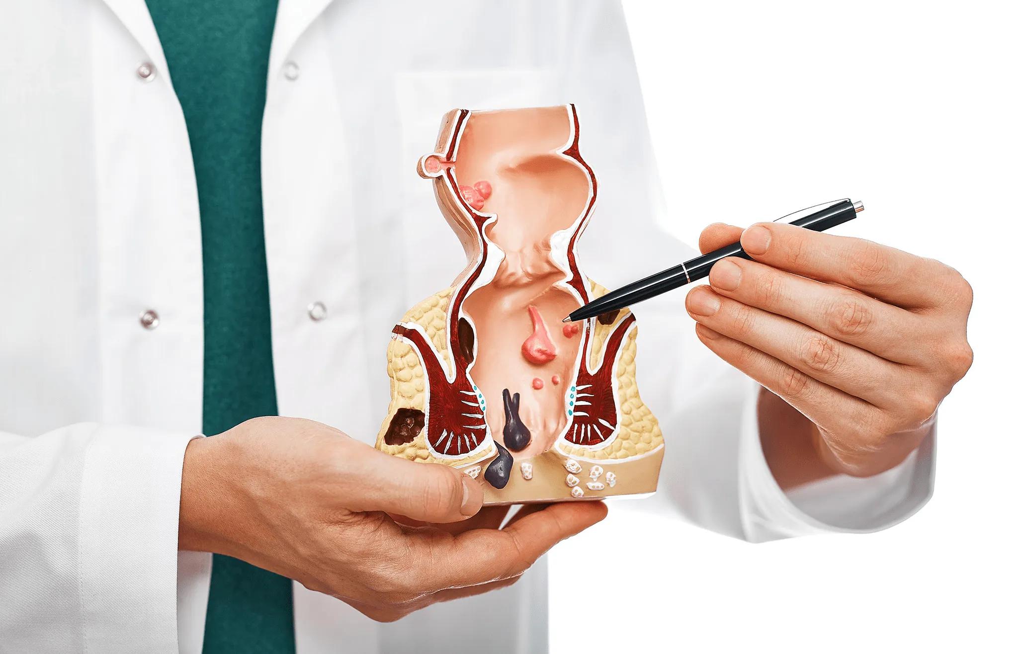 Can Piles Treatment Be Performed Without Surgery?
