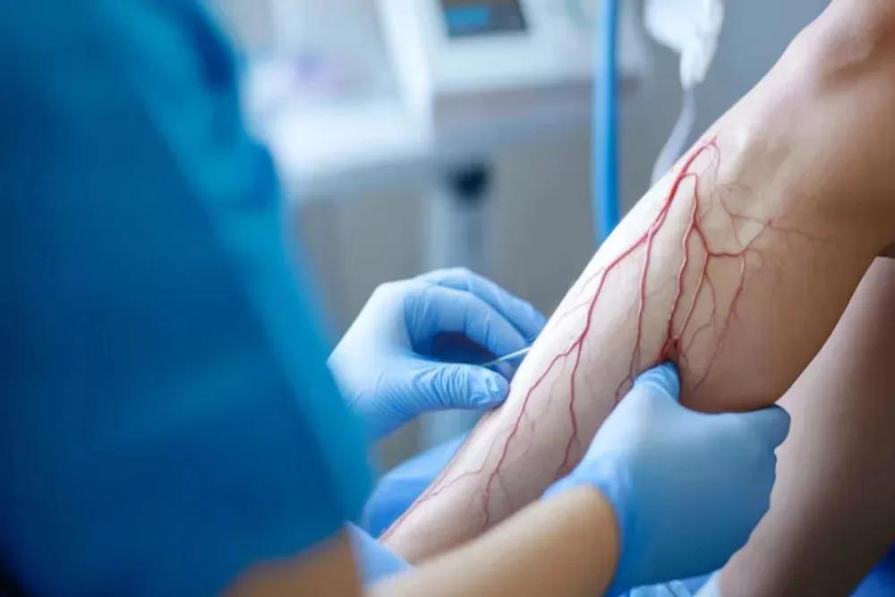Can Vascular Surgery Prevent Serious Complications?